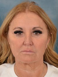 Brow Lift Before & After Gallery - Patient 114184 - Image 1
