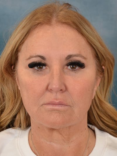 Brow Lift Before & After Gallery - Patient 114184 - Image 1