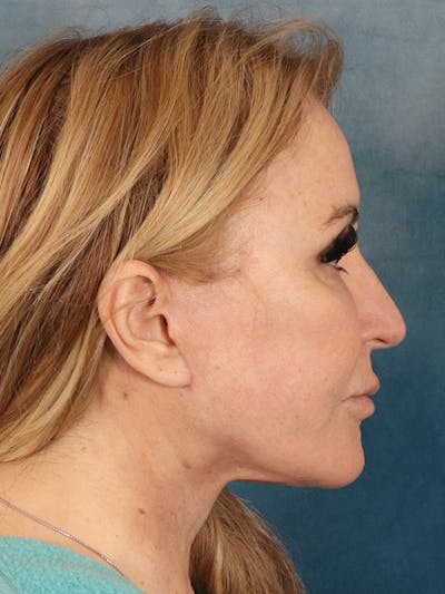 Brow Lift Before & After Gallery - Patient 114184 - Image 10