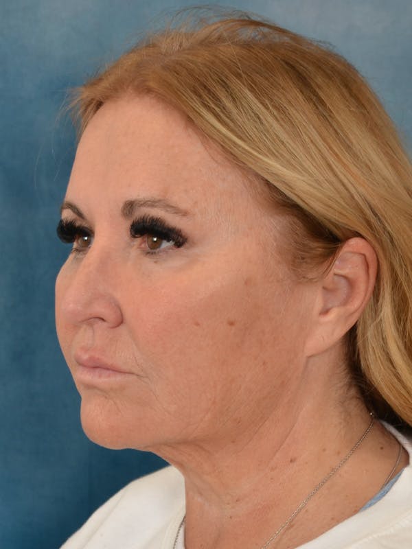 Brow Lift Before & After Gallery - Patient 114184 - Image 3