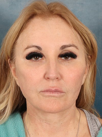 Brow Lift Before & After Gallery - Patient 114184 - Image 2
