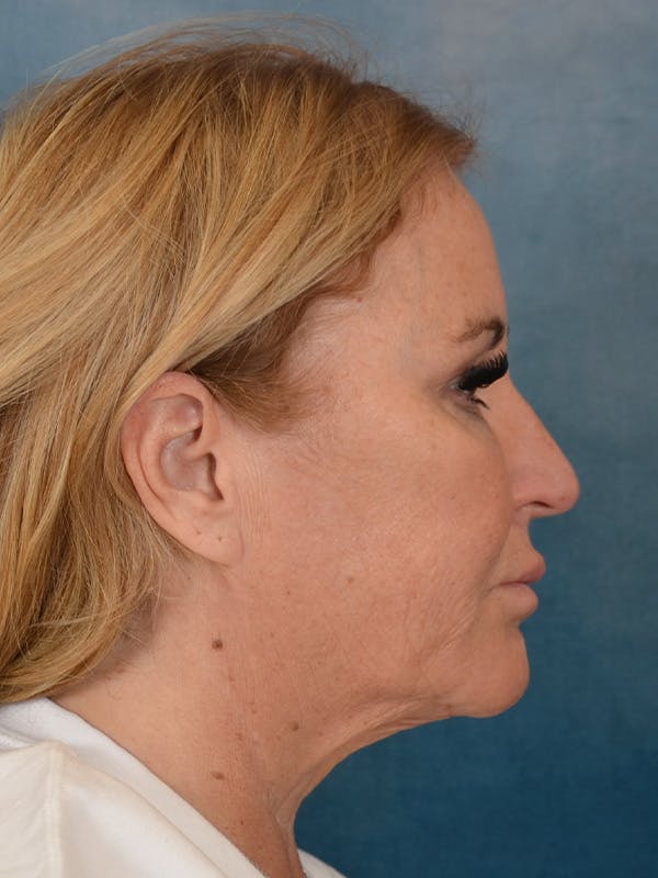 Brow Lift Before & After Gallery - Patient 114184 - Image 9