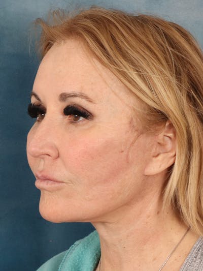 Brow Lift Before & After Gallery - Patient 114184 - Image 4