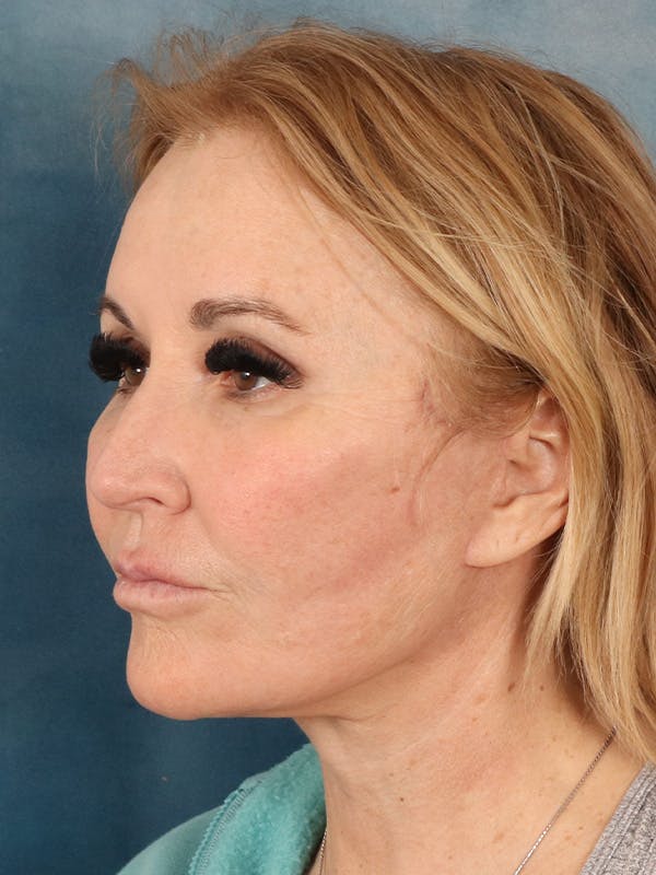 Brow Lift Before & After Gallery - Patient 114184 - Image 4