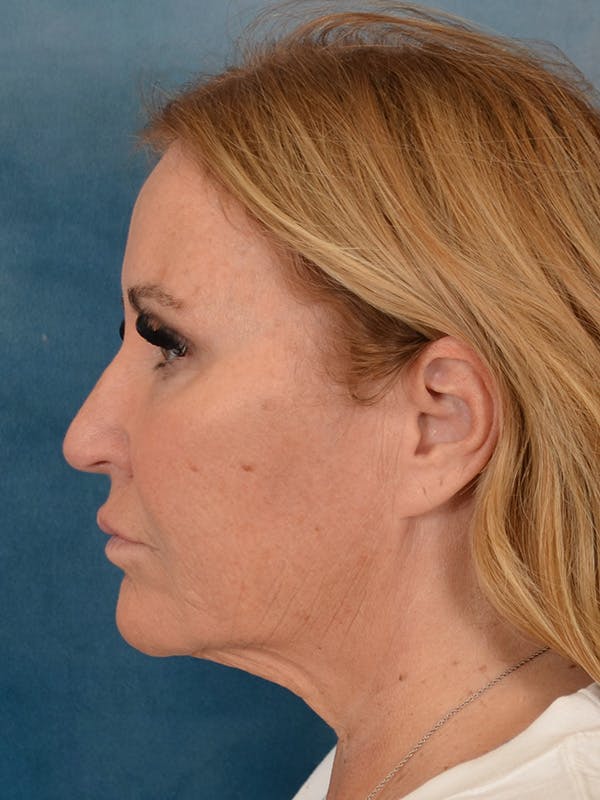 Brow Lift Before & After Gallery - Patient 114184 - Image 5