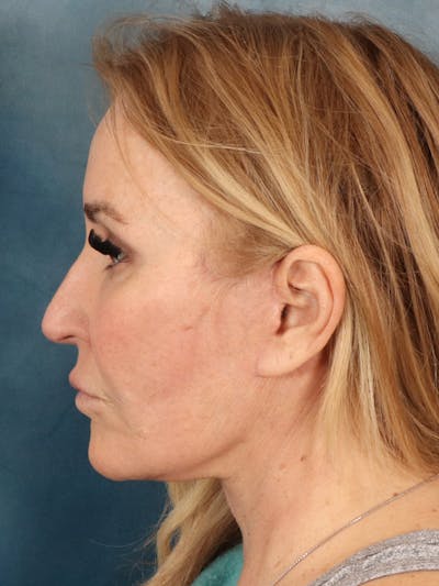 Brow Lift Before & After Gallery - Patient 114184 - Image 6