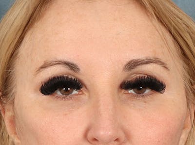 Eyelid Lift Before & After Gallery - Patient 126324 - Image 2