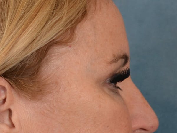 Eyelid Lift Before & After Gallery - Patient 126324 - Image 5