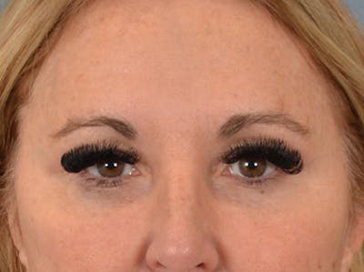Eyelid Lift Before & After Gallery - Patient 126324 - Image 1
