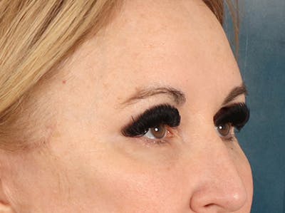 Eyelid Lift Before & After Gallery - Patient 126324 - Image 4