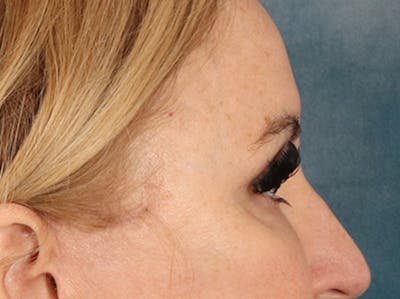 Eyelid Lift Before & After Gallery - Patient 126324 - Image 6