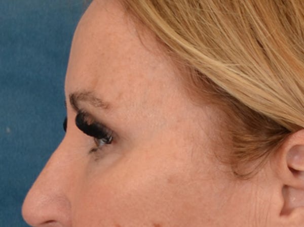 Eyelid Lift Before & After Gallery - Patient 126324 - Image 9