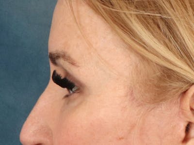 Eyelid Lift Before & After Gallery - Patient 126324 - Image 10