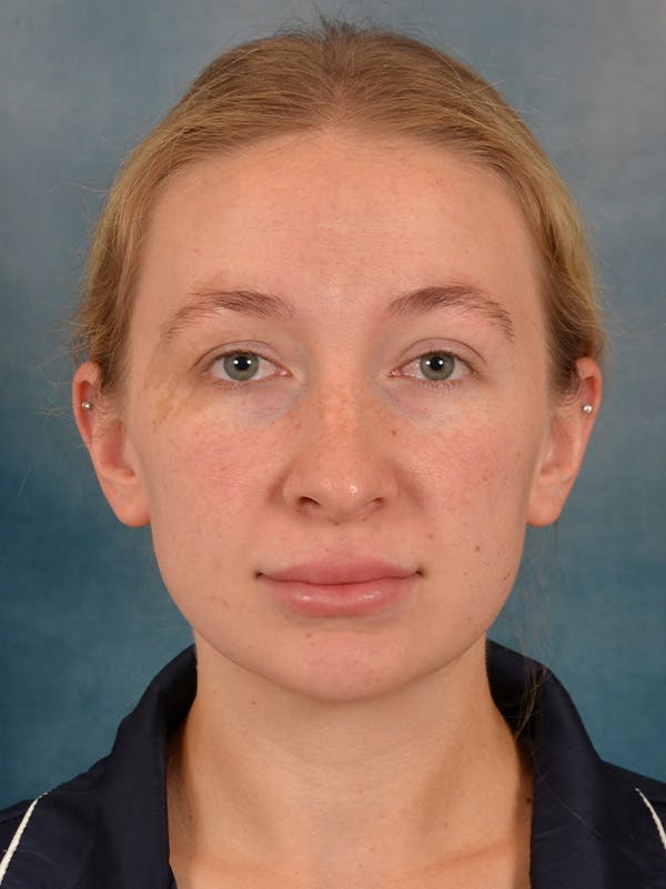 Rhinoplasty Before & After Gallery - Patient 838181 - Image 5