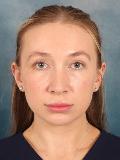 Rhinoplasty Before & After Gallery - Patient 838181 - Image 6