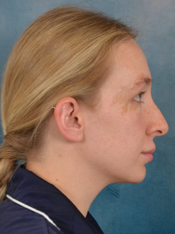 Rhinoplasty Before & After Gallery - Patient 838181 - Image 9