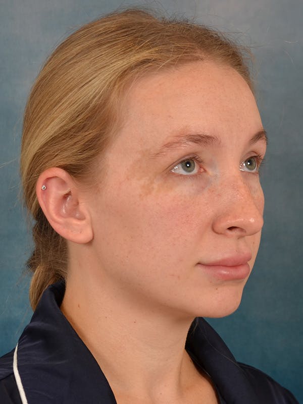 Rhinoplasty Before & After Gallery - Patient 838181 - Image 7