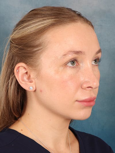 Rhinoplasty Before & After Gallery - Patient 838181 - Image 8