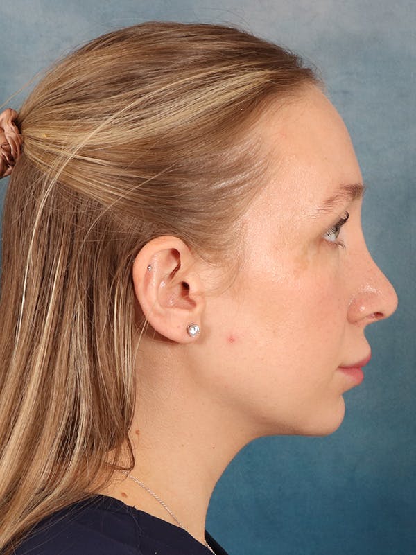 Rhinoplasty Before & After Gallery - Patient 838181 - Image 10