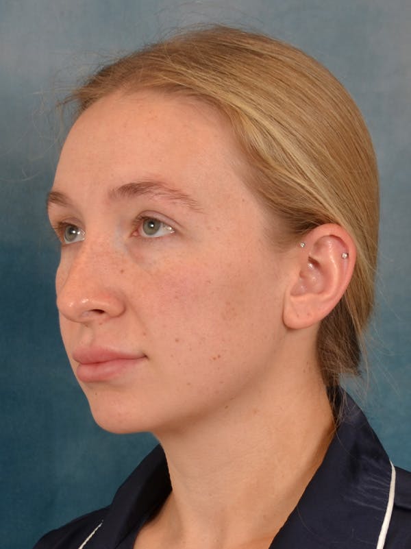 Rhinoplasty Before & After Gallery - Patient 838181 - Image 3