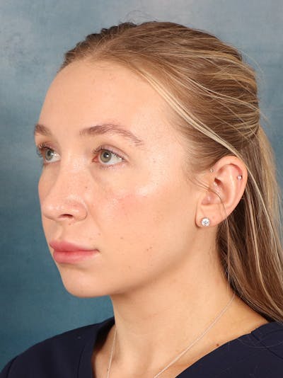 Rhinoplasty Before & After Gallery - Patient 838181 - Image 4