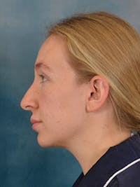 Rhinoplasty Before & After Gallery - Patient 838181 - Image 1