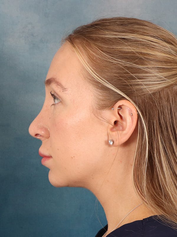 Rhinoplasty Before & After Gallery - Patient 838181 - Image 2