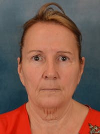 Deep Neck Lift Before & After Gallery - Patient 112823 - Image 1