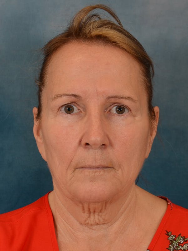 Deep Neck Lift Before & After Gallery - Patient 112823 - Image 1