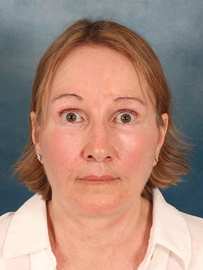 Deep Neck Lift Before & After Gallery - Patient 112823 - Image 2