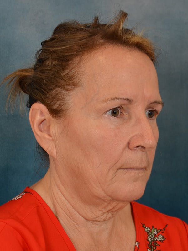 Deep Neck Lift Before & After Gallery - Patient 112823 - Image 7