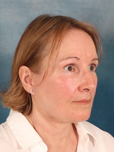 Deep Neck Lift Before & After Gallery - Patient 112823 - Image 8