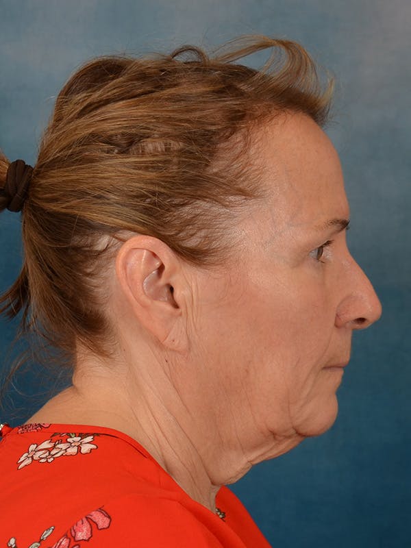 Deep Neck Lift Before & After Gallery - Patient 112823 - Image 9