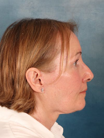 Deep Neck Lift Before & After Gallery - Patient 112823 - Image 10