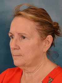 Deep Plane Facelift Before & After Gallery - Patient 148969 - Image 1