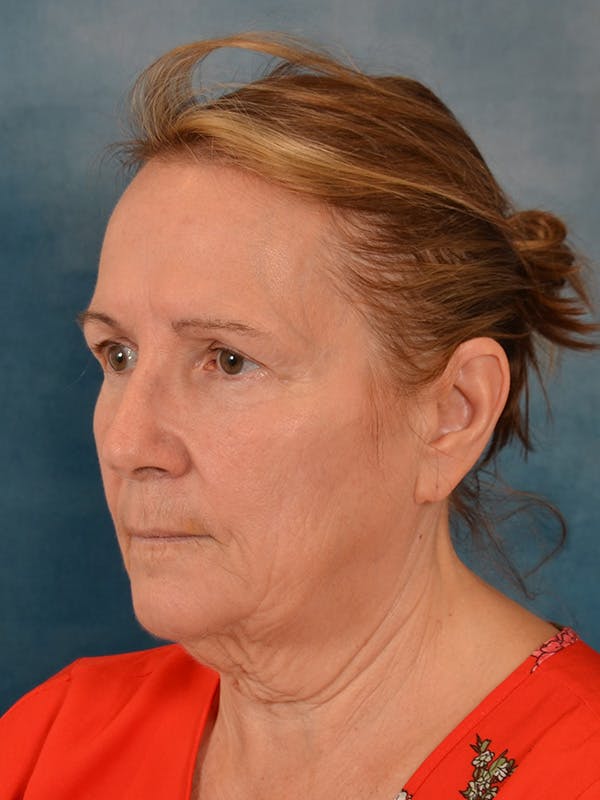 Deep Neck Lift Before & After Gallery - Patient 112823 - Image 3