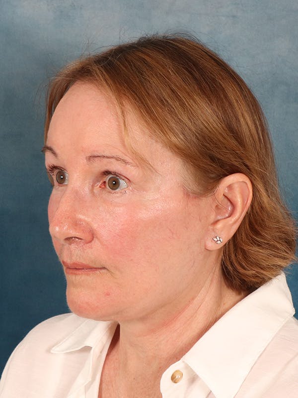 Deep Neck Lift Before & After Gallery - Patient 112823 - Image 4