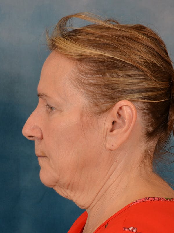 Deep Neck Lift Before & After Gallery - Patient 112823 - Image 5