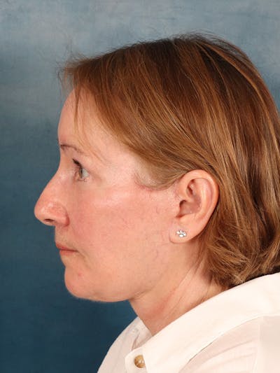 Deep Neck Lift Before & After Gallery - Patient 112823 - Image 6