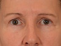 Eyelid Lift Before & After Gallery - Patient 180291 - Image 1
