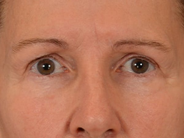 Eyelid Lift Before & After Gallery - Patient 180291 - Image 1