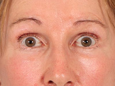 Eyelid Lift Before & After Gallery - Patient 180291 - Image 2