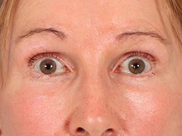 Eyelid Lift Before & After Gallery - Patient 180291 - Image 2
