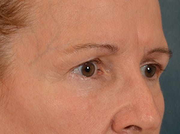 Eyelid Lift Before & After Gallery - Patient 180291 - Image 3