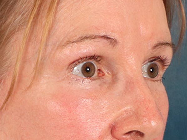 Eyelid Lift Before & After Gallery - Patient 180291 - Image 4