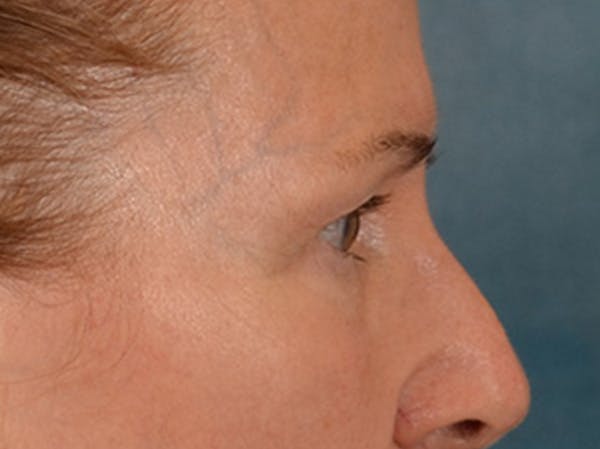 Eyelid Lift Before & After Gallery - Patient 180291 - Image 5