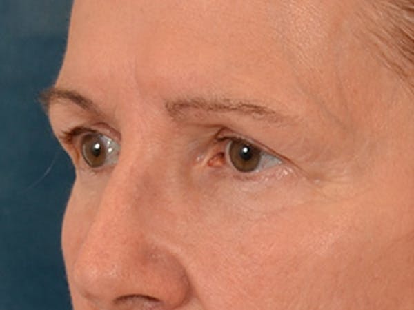 Eyelid Lift Before & After Gallery - Patient 180291 - Image 7