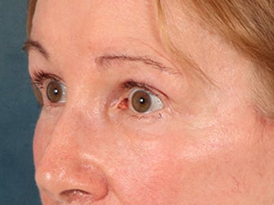 Eyelid Lift Before & After Gallery - Patient 180291 - Image 8