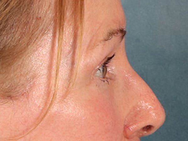 Eyelid Lift Before & After Gallery - Patient 180291 - Image 6