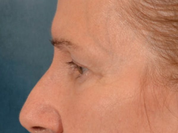 Eyelid Lift Before & After Gallery - Patient 180291 - Image 9
